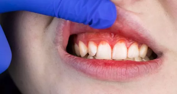 What actually causes bad breath?