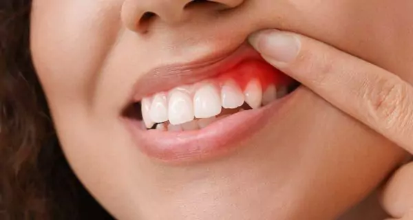What are the effects of radiotherapy on oral health?
