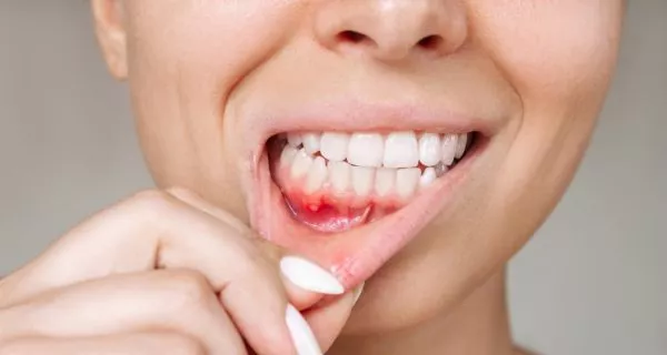 What causes gum disease?