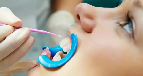 What professional treatments help prevent cavities?
