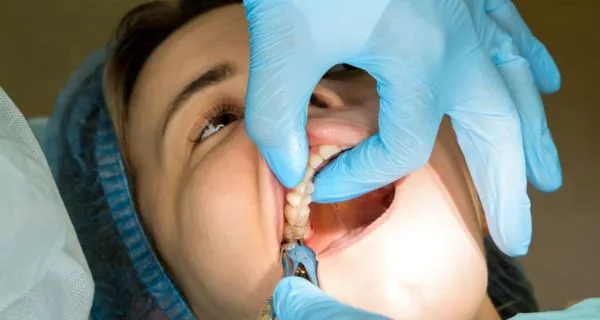 ¿La extracción de dientes detiene el dolor?