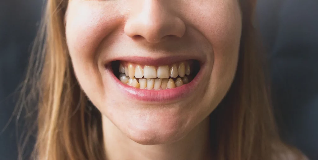 Why Are People Talking About Ozempic Teeth?