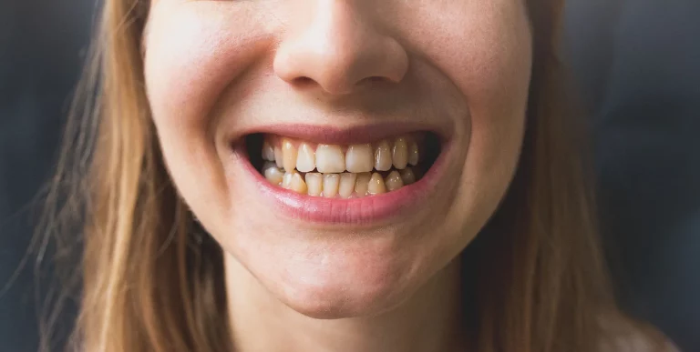 Why Are People Talking About Ozempic Teeth?