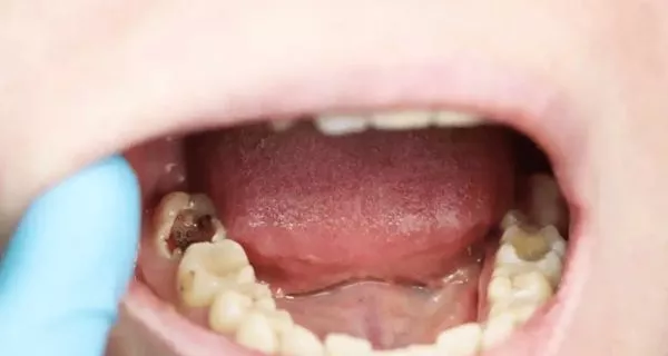 ¿Por qué a veces es necesaria la extracción de dientes?