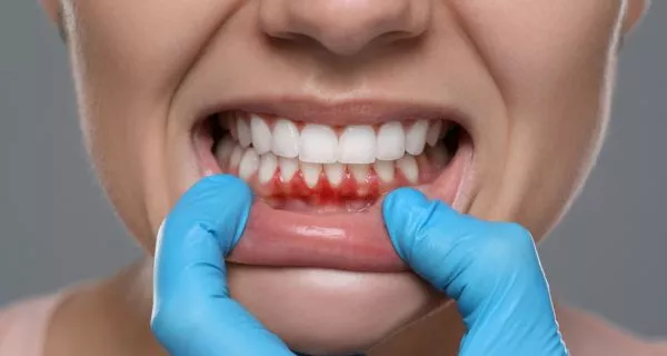 What happens when the mouth is too dry?