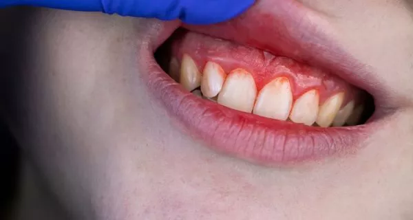 Can periodontal disease be prevented during pregnancy?