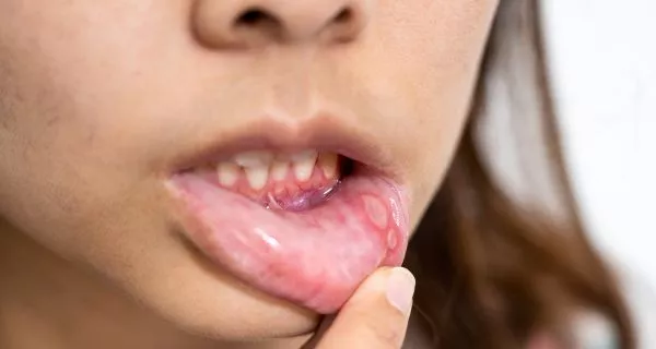 Causes of transient lingual papillitis