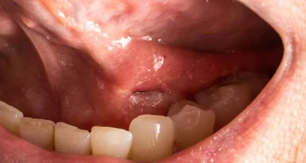 ¿Cómo deshacerse del reflejo nauseoso?