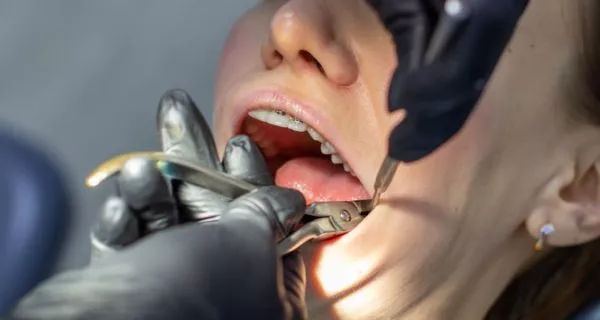 Extracciones dentales y diabetes