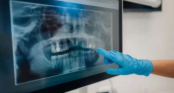 How are cavities in between teeth diagnosed?