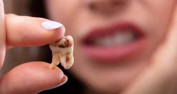 How are complicated tooth fractures treated?