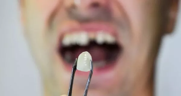 How does a broken tooth happen?