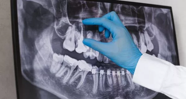 La extracción y su manejo