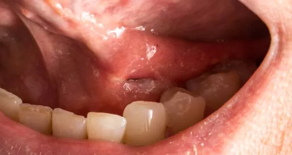 Stages in which an abscess develops