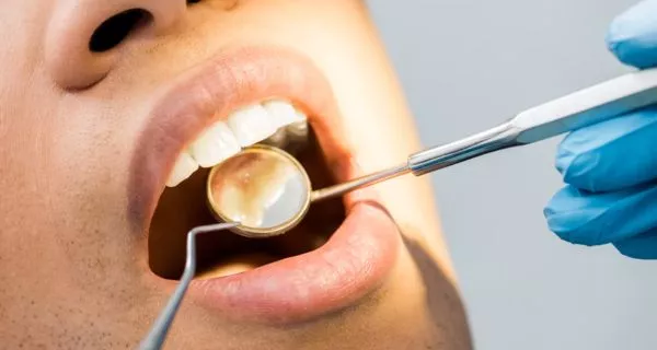 What are cavities in between teeth?