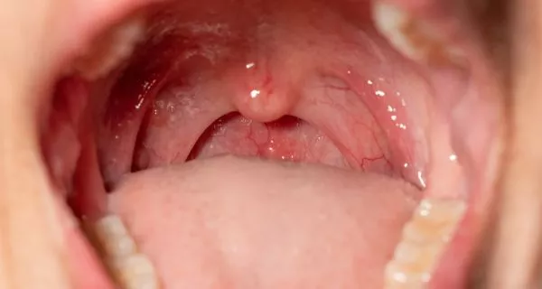 What are Tonsil Stones or Tonsillitis?