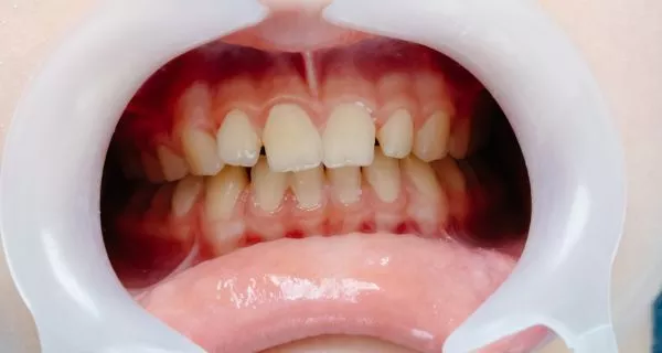 What causes trench mouth?