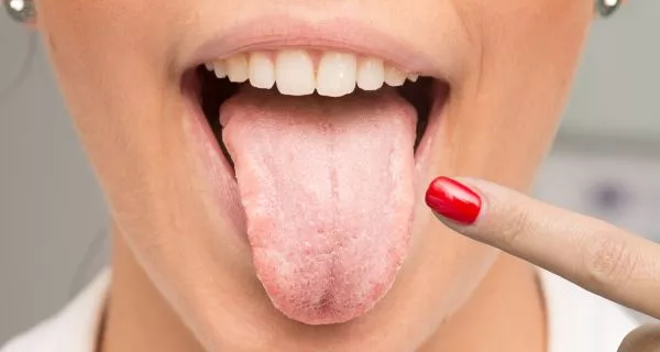 What is Burning Mouth Syndrome?