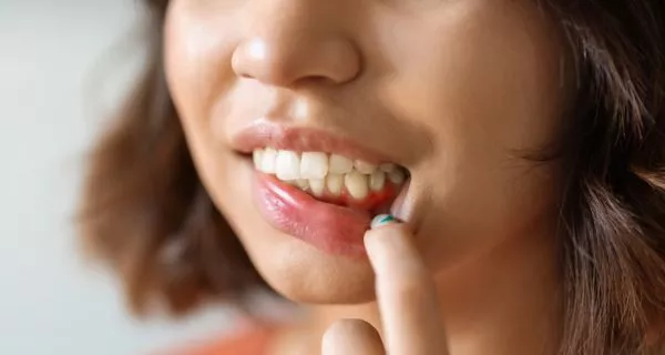 1. Plaque Buildup and Gum Disease