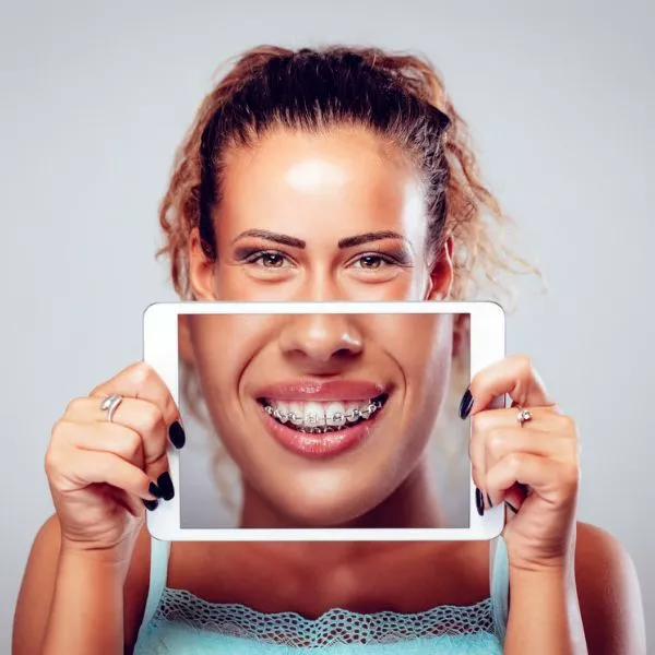 clear-braces-2-69c2986599e58