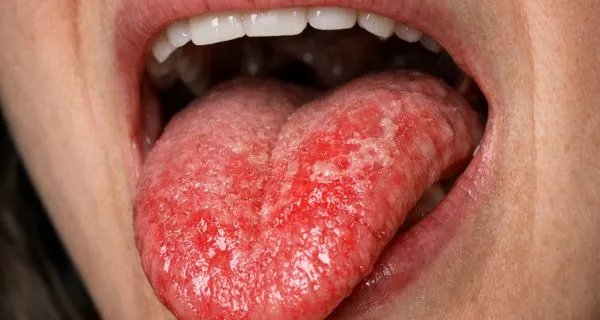 What does burning mouth syndrome feel like?
