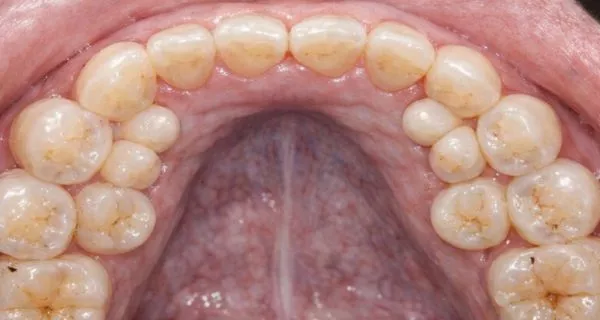 What is hyperdontia?