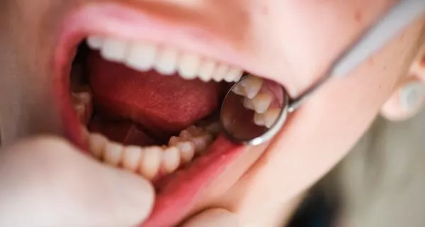 Why are pregnant women more likely to get cavities?