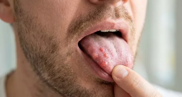 What is transient lingual papillitis?